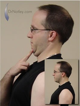 Winnipeg Chiropractor performing neck retractions
